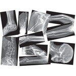 Roylco Broken Bones X-rays Set
