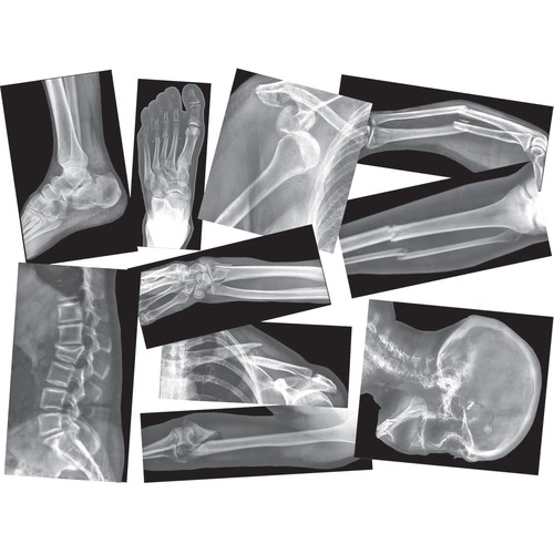 Roylco Broken Bones X-Ray - Theme/Subject: Radiology - Skill Learning: Anatomy - 5+ - 15 / Pack