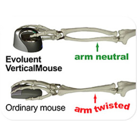 Evoluent VerticalMouse 4 Right Mouse - Optical - Cable - 1 Pack - USB 2.0 - 2600 dpi - Scroll Wheel - 6 Button(s) - 6 Programmable Button(s) - Right-handed Only = ELUVM4R